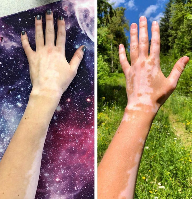 Vitiligo.jpg