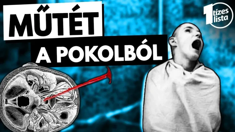 Az orvostudomány sötét oldala – A LOBOTÓMIA – videó