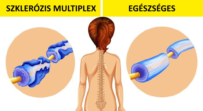 Szklerózis multiplex elleni védelem