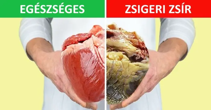 Zsigeri zsír: Miért veszélyes és hogyan kezeljük?