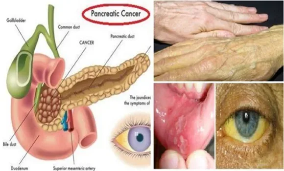 A hasnyálmirigyrák 8 figyelmeztető tünete, amit mindenki ismerni kell