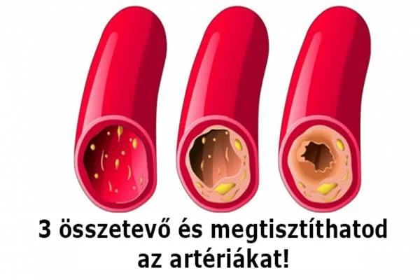 Távolítsuk el a szívérrendszer lerakódásait, használva ez a 3 természetes alapanyag!